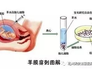關(guān)于羊水穿刺科普