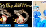 蘭大二院完成省內(nèi)首例全肩關(guān)節(jié)鏡下自體髂骨植骨術(shù)、Remplissage術(shù)和肩袖修補(bǔ)術(shù)治療習(xí)慣性肩關(guān)節(jié)脫位合并肩袖損傷
