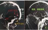 蘭大二院成功救治一名罕見(jiàn)復(fù)雜危重的顱內(nèi)感染性靜脈竇血栓患兒