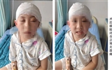 蘭大二院成功為一名顱眶溝通腫瘤兒童完成腫瘤切除手術(shù)