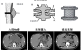 蘭大二院普通外科聯(lián)合消化內(nèi)科使用LAMS支架完成一例胰腺假性囊腫手術(shù)