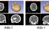 蘭大二院成功實(shí)施經(jīng)外側(cè)裂基底節(jié)腦出血顯微清除術(shù)救治高血壓性腦出血患者