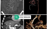 為門靜脈完全栓塞患者“重啟生命通道”——蘭大二院消化內(nèi)科實施省內(nèi)首例EUS - TIPS